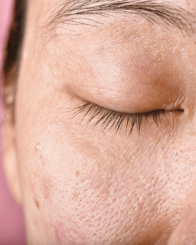 manchas en la piel dr jose becerra